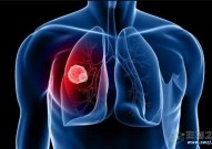 Cancer Discovery：迄今为止最大规模的小细胞肺癌队列研究
