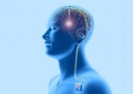 首个人体临床试验：脑深部电刺激治疗中风，加速患者运动功能恢复，已成立公司转化