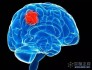 Nature颠覆性发现：大脑思考，促进肿瘤生长！胶质瘤通过劫持神经元影响认知和生存
