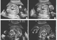 胎儿也能“怀孕”？孕妈产前检查惊现罕见“胎中胎（寄生胎）”！