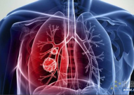 D+T组合疗法突破转移性非小细胞肺癌生存壁垒