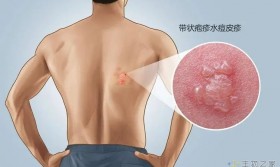 一旦感染终身携带！发作痛不欲生，超90%成人体内潜伏这种带状疱疹病毒