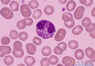 Cancer Cell：中性粒细胞胞外陷阱促进化疗耐药性产生