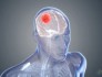 NEJM：20多年来胶质瘤治疗的首个重大突破，大幅延长患者生存期