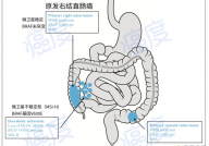 81岁肠癌老人的病灶全消失，只因为她做了肿瘤基因检测？