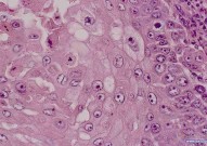 Cancer Cell：T细胞缺陷而非染色体不稳定致使短端粒综合征患者易患鳞状细胞癌