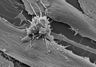 免疫细胞当“黑客”治疗癌症，基因编辑CAR-T癌症疗法