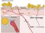 Cell：首次证明一种常见的皮肤细菌可以通过直接作用于神经细胞而引起瘙痒