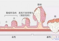 最“凶险”的遗传性息肉病，平均发病年龄16岁，平均癌变年龄39岁，平均死亡年龄40岁！