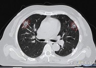 新冠病毒对你的肺做了什么？CT扫描来告诉你