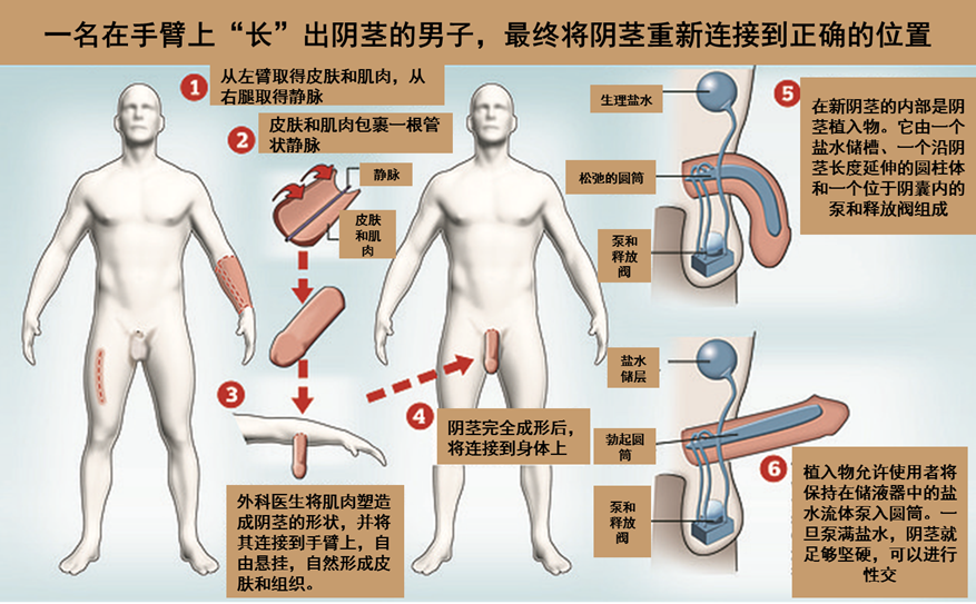 在手臂上定值3D打印鼻子和定制阴茎尺寸，并成功移植给患者！